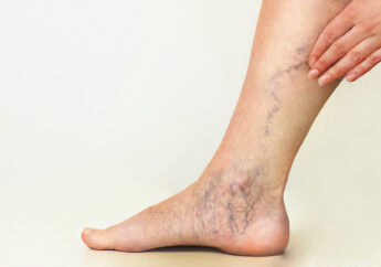 Deep Vein Thrombosis - What Is It and How Can You Avoid It?